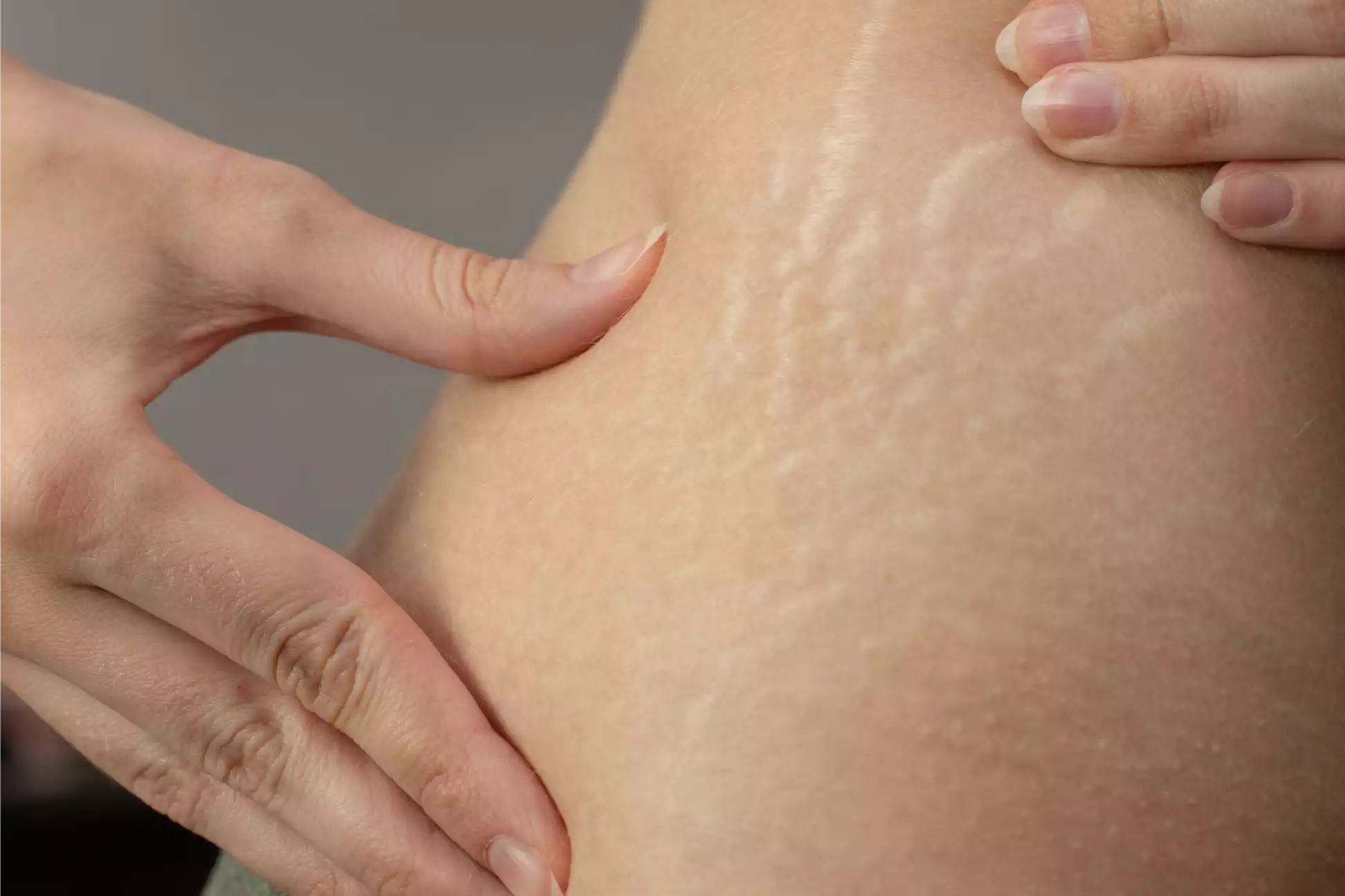 Beyond the maternal glow. Common pregnancy-related skin problems